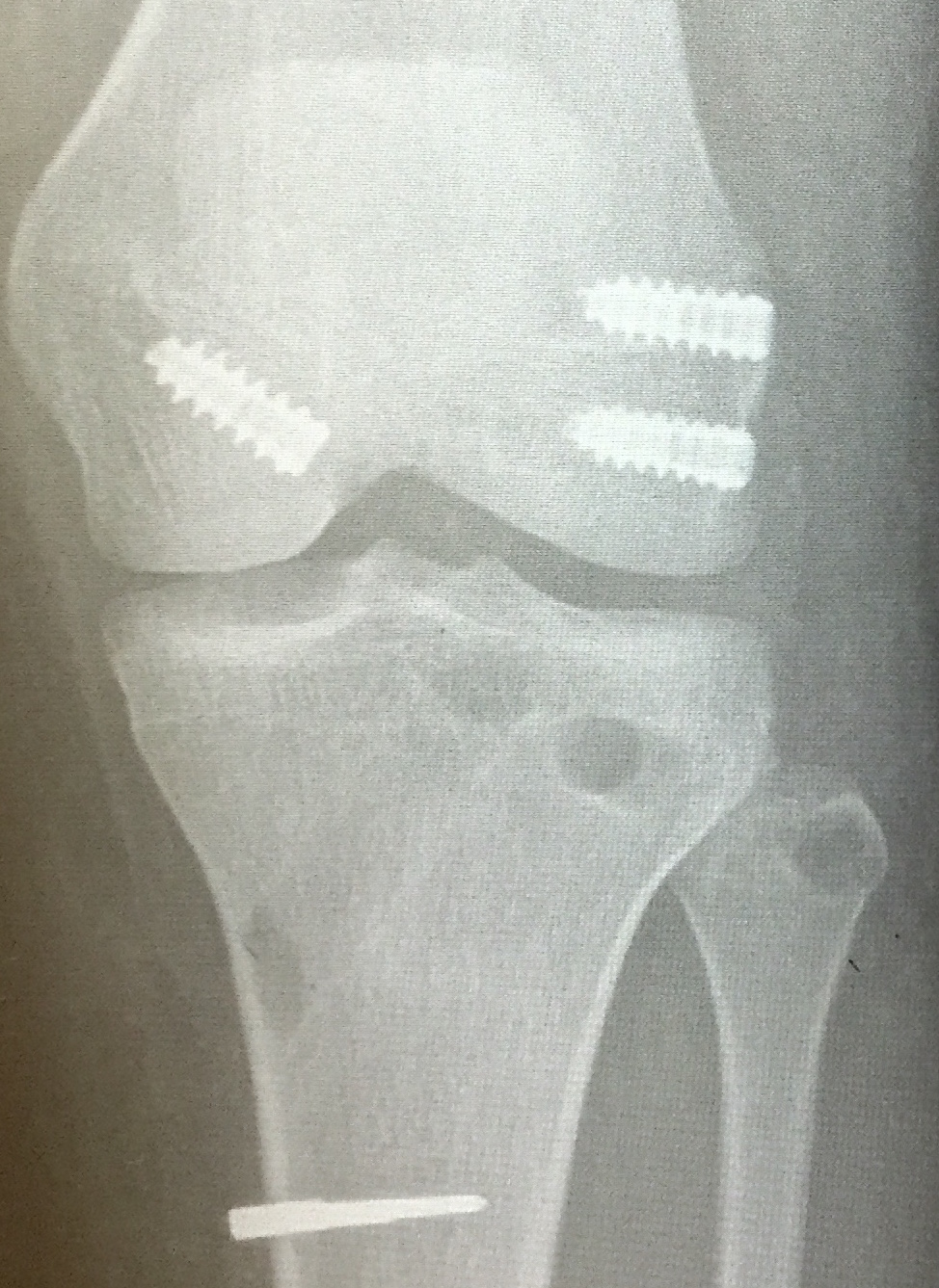 PCL Posterolateral Corner LaPrade 1